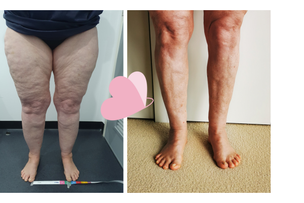 (Left Image) Pre-Surgery (Right Image) Post Second Surgery